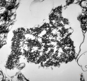 M,71y. | Alzheimer diseaseaccompanied with CADASIL - hyaline body in astrocyte M,71y. | Alzheimer diseaseaccompanied with CADASIL - hyaline body in astrocyte